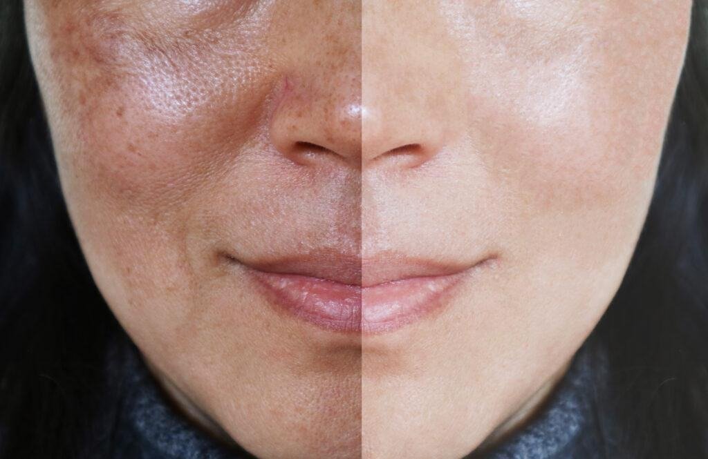 How to Make Hydroquinone Work Faster for Melasma: Evidence-Based Strategies
